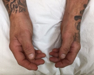 APB atrophy 2.JPG