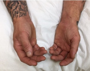 APB atrophy 1.jpg